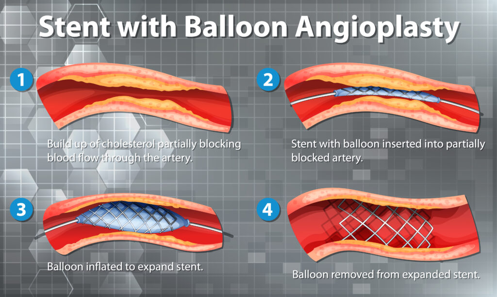 Angioplasty